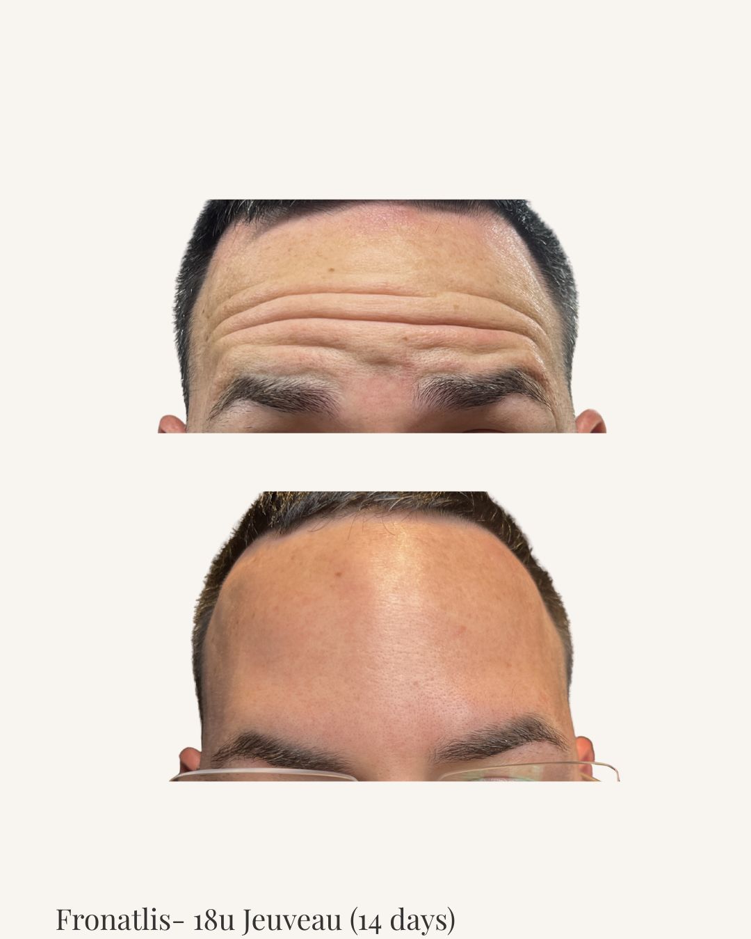 Frontalis — Antes & Después · Jeuveau · 18u